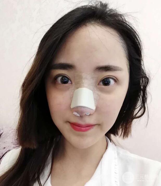 東莞寶格麗韋文奇隆鼻整形果圖分享，對比曝光