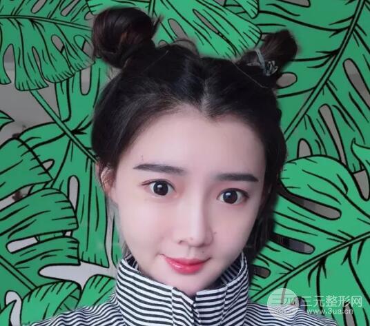 脂肪填充全臉恢復(fù)過(guò)程圖