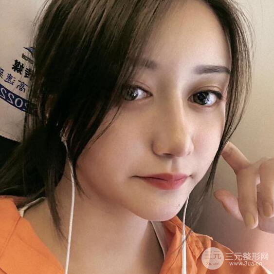 廣州名韓醫(yī)療美容卓敬錫“隆鼻整形+自體脂肪填充全臉”案例分享，整完有點像景甜