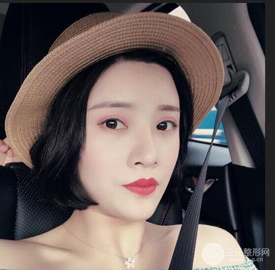 銀川崔大夫博士麗朱杰自體脂肪豐面頰恢復(fù)記錄附對比圖片