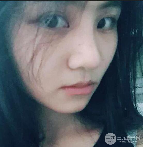 泉州億星醫(yī)療美容閔英俊膨體隆鼻果展示