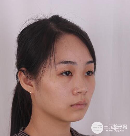 杭州恒顏醫(yī)療美容趙德星隆鼻整形手術(shù)恢復(fù)過(guò)程圖