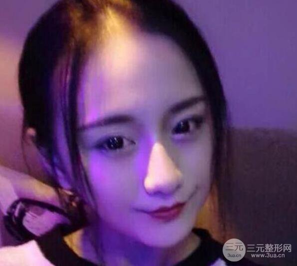 三亞三仁醫(yī)療美容于德印全切雙眼皮+開眼角一個(gè)月恢復(fù)圖來辣