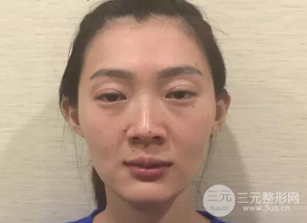 脂肪填充全臉恢復(fù)過(guò)程圖