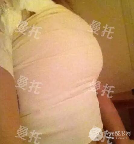 分享我的曼托隆胸圖片