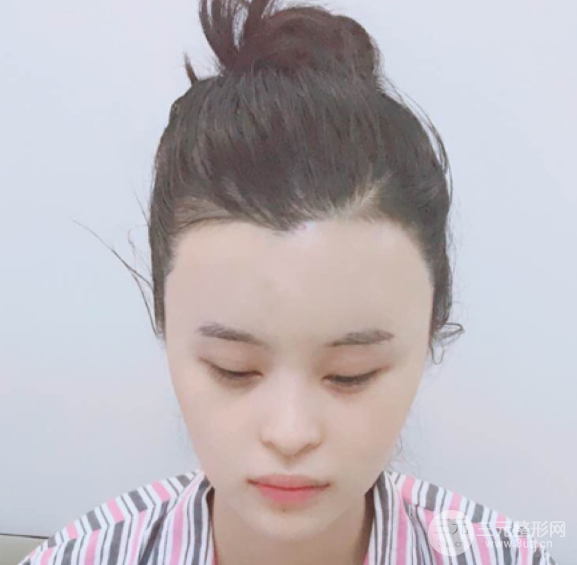 自體脂肪填充一個(gè)月真實(shí)恢復(fù)圖片，恢復(fù)后連閨蜜都驚艷辣