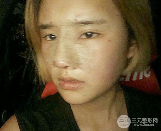 南京美范整形沈干“自體脂肪填充+隆鼻整形”真人記錄分享