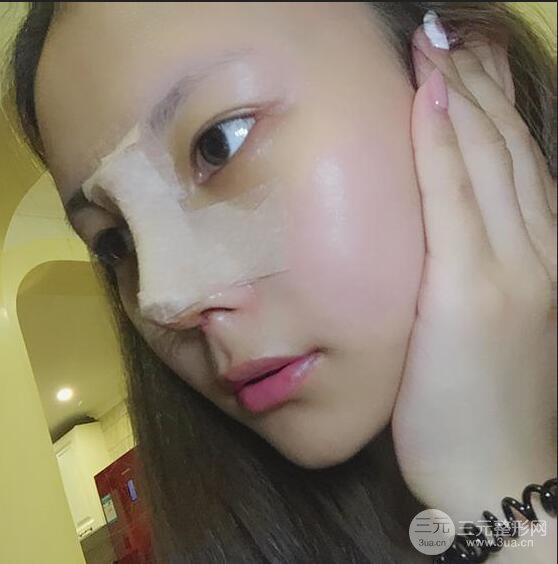 杭州恒顏醫(yī)療美容趙德星肋軟骨隆鼻術(shù)后六十天全記錄