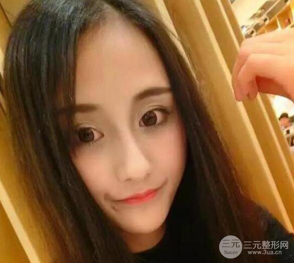 三亞三仁醫(yī)療美容于德印全切雙眼皮+開眼角一個(gè)月恢復(fù)圖來辣