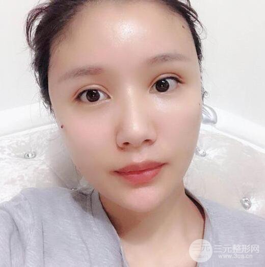 辣媽做了自體脂肪填充全臉，對比圖分享