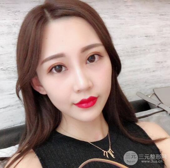 割雙眼皮兩個(gè)月是啥樣，妹子公開(kāi)恢復(fù)記錄