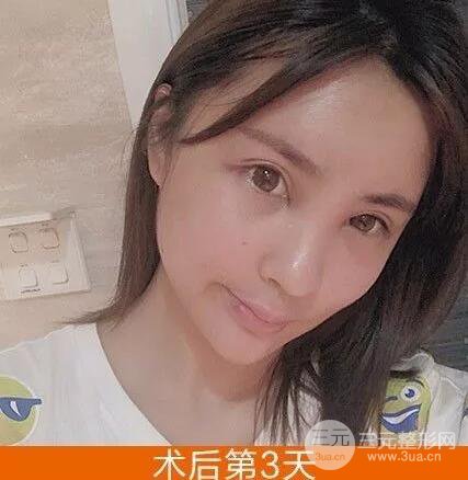 我的自體脂肪臉部填充日記