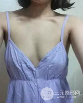 假體隆胸分享日記