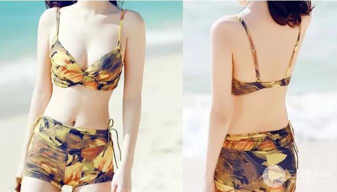 腹腰吸脂三個月圖片