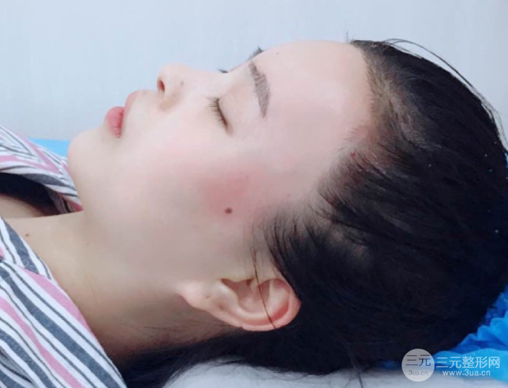 自體脂肪填充一個(gè)月真實(shí)恢復(fù)圖片，恢復(fù)后連閨蜜都驚艷辣