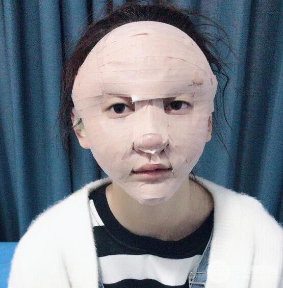 廣州名韓醫(yī)療美容卓敬錫“隆鼻整形+自體脂肪填充全臉”案例分享，整完有點像景甜