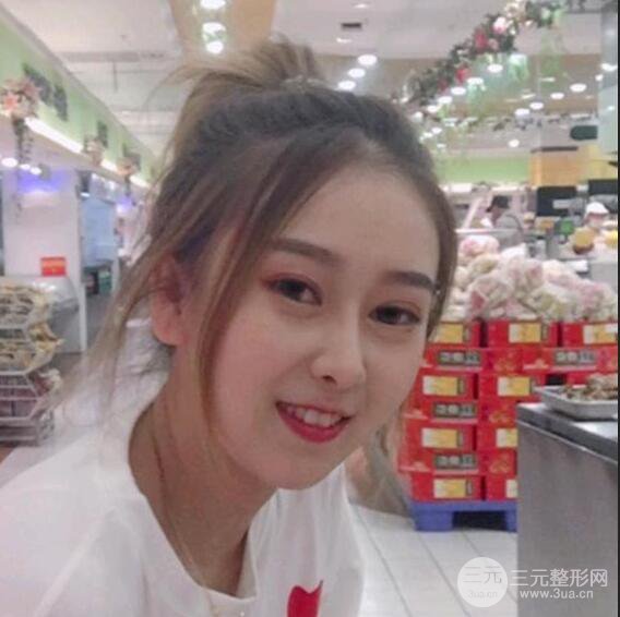 三亞三仁于德印肋軟骨隆鼻+硅膠墊下巴恢復(fù)對比圖