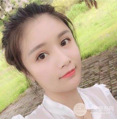 辣媽做了自體脂肪填充全臉，對比圖分享