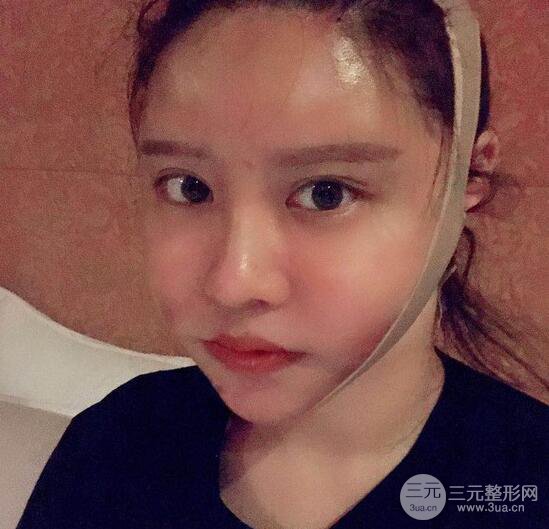 減肥太辛苦了，我還是做個面部吸脂來逆襲