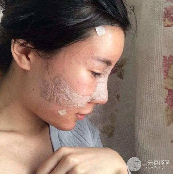 自體脂肪面部填充果對比圖