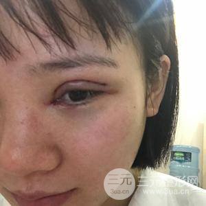 全切雙眼皮半個月恢復(fù)全記錄