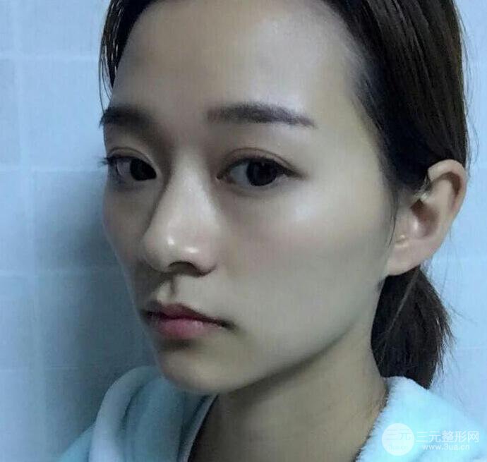 自體脂肪全臉填充三個(gè)月恢復(fù)圖，真實(shí)案例分享