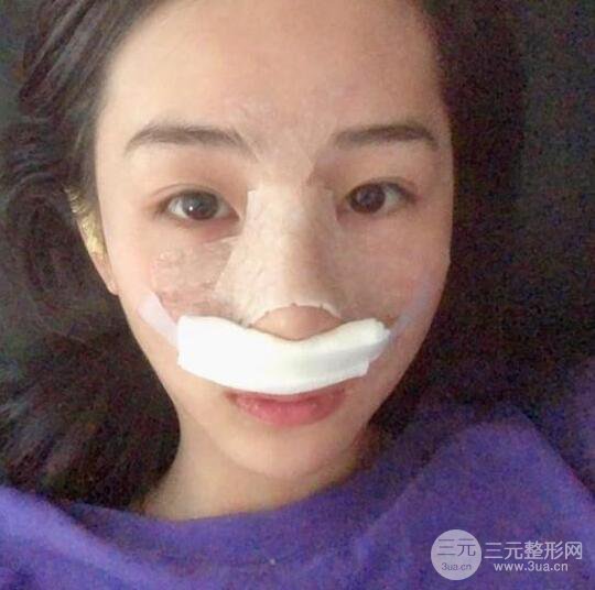 東莞寶格麗醫(yī)療美容韋文奇隆鼻整形60天恢復圖片