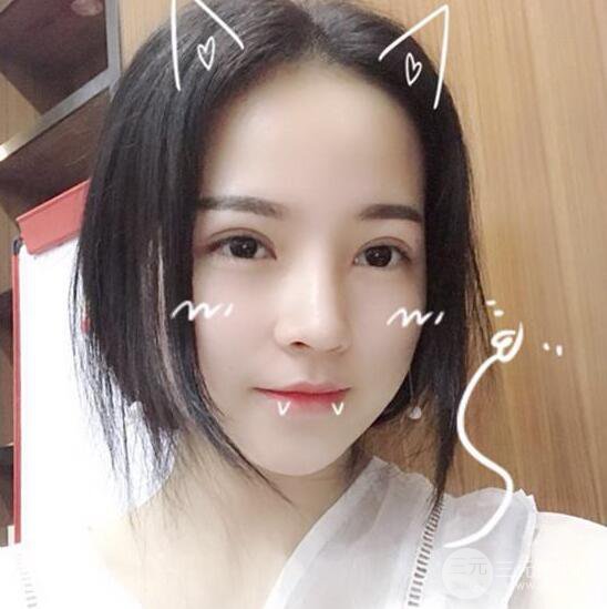 銀川崔大夫博士麗醫(yī)療美容朱杰膨體隆鼻果反饋