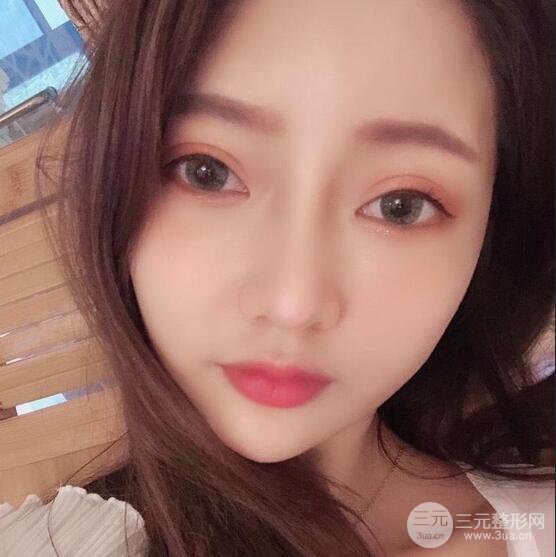 只是做了隆鼻整形改變居然辣么大，快來(lái)看看我的隆鼻整形恢復(fù)日記叭