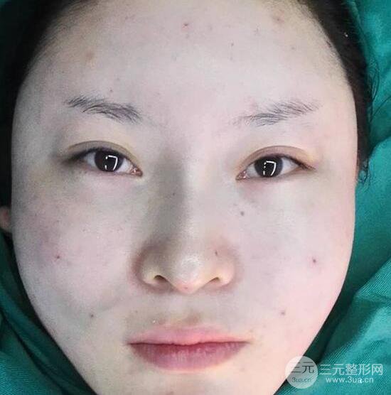 自體脂肪面部填充果怎么樣？對(duì)比反饋