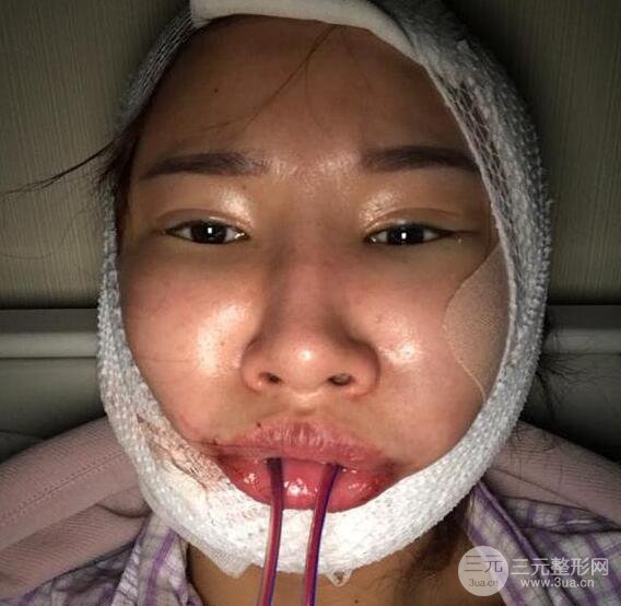 去下頜角+顴骨內(nèi)推手術(shù)三個(gè)月記錄，看大臉妹如何逆襲