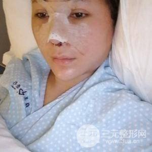 進(jìn)口假體+肋軟骨墊鼻尖三個(gè)月果恢復(fù)對(duì)比圖