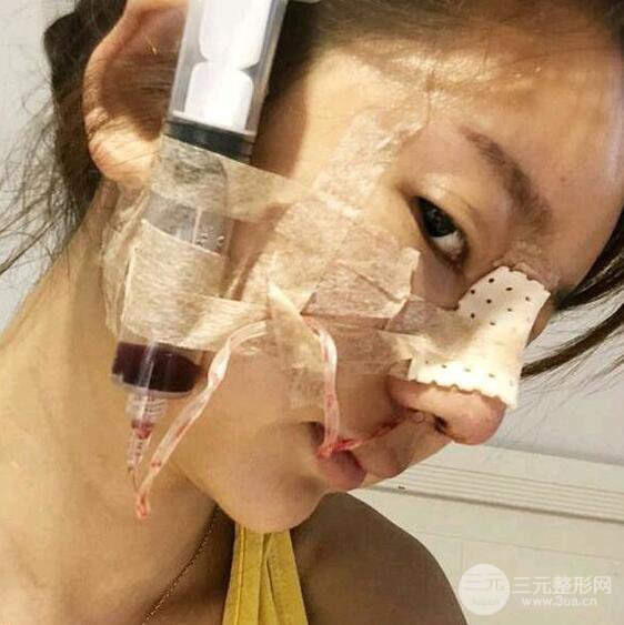 只是做了隆鼻整形改變居然辣么大，快來(lái)看看我的隆鼻整形恢復(fù)日記叭