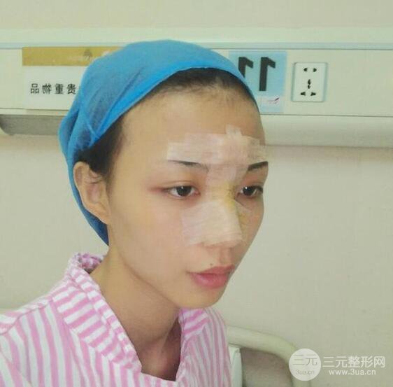 凸嘴先別急著正頜，做個(gè)隆鼻整形會(huì)更美