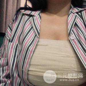 假體隆胸三個月恢復(fù)圖