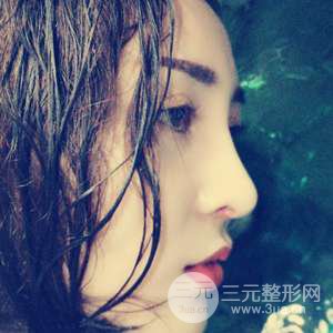 進(jìn)口假體+肋軟骨墊鼻尖三個(gè)月果恢復(fù)對(duì)比圖