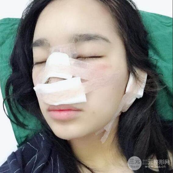 隆鼻整形術前術后對比照曝光，附經驗分享及心得體會