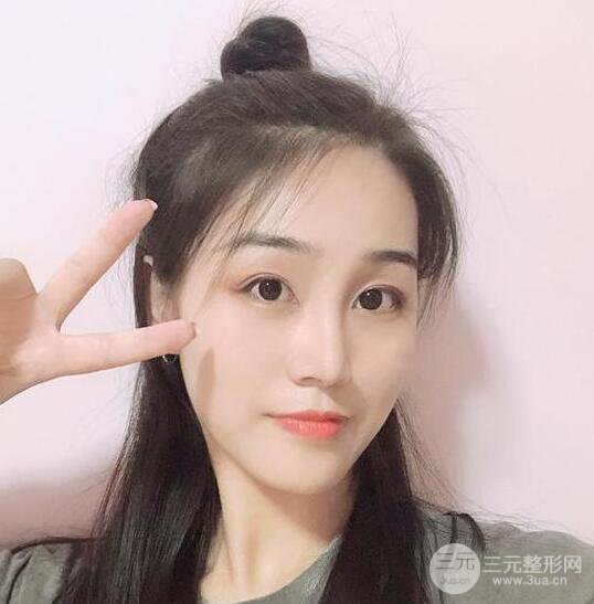 東莞寶格麗醫(yī)療美容韋文奇隆鼻整形60天恢復圖片