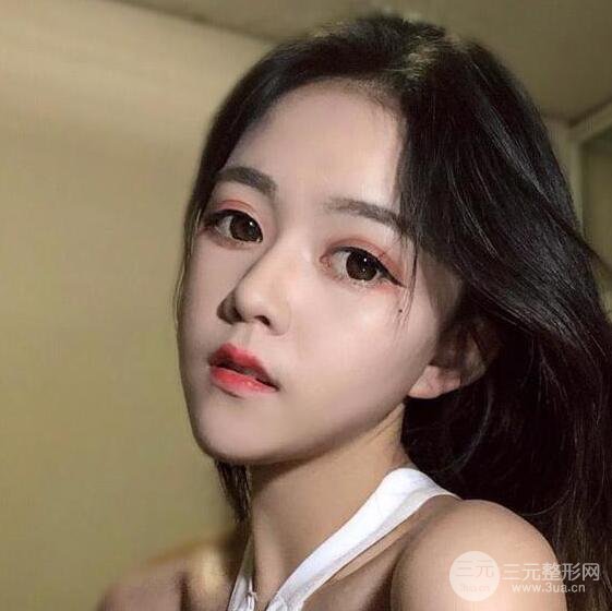 泉州億星醫(yī)療美容閔英俊切開雙眼皮果對(duì)比