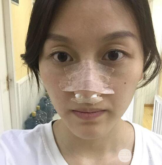 做了“埋埋蛋白線.提升+隆鼻整形”，恢復(fù)后老公說很沒有降低風(fēng)險(xiǎn)感