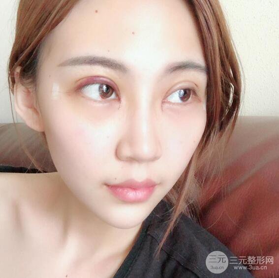 割雙眼皮兩個(gè)月是啥樣，妹子公開(kāi)恢復(fù)記錄