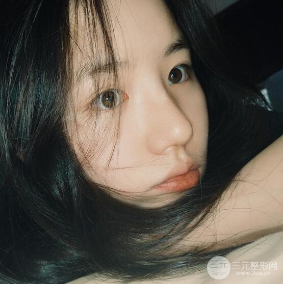 上海華美醫(yī)療美容李庭勛膨體隆鼻怎么樣？果對(duì)比圖