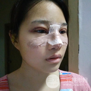 雙眼皮多項整形隆鼻整形一起做怎么樣？真人曝光果對比圖