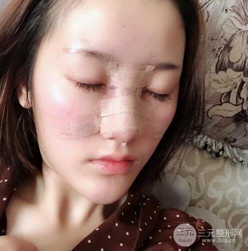 膨體隆鼻三十天恢復(fù)記錄，術(shù)前術(shù)后對比圖片曝光
