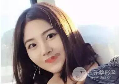 綜合隆鼻前后對(duì)比照片案例