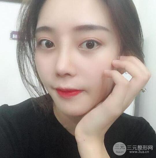 自體軟骨隆鼻恢復(fù)記錄，附對(duì)比圖片