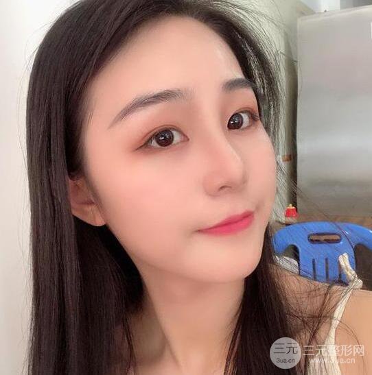 東莞寶格麗醫(yī)療美容韋文奇隆鼻整形60天恢復圖片