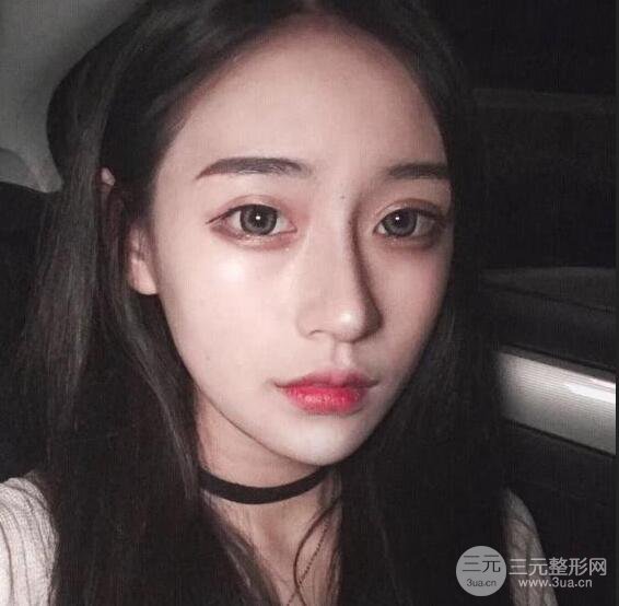 河南中醫(yī)藥大學(xué)第(一)附屬醫(yī)院趙絳波削下頜角恢復(fù)對(duì)比圖