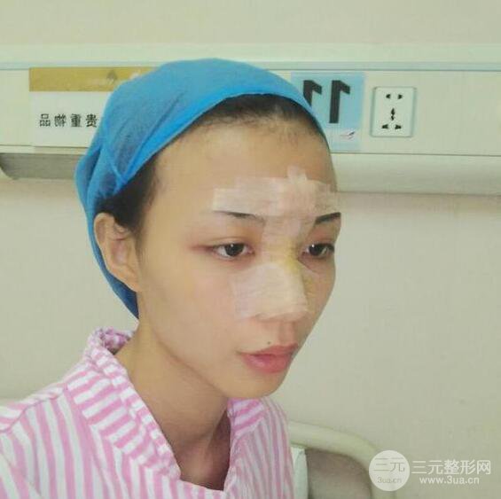 銀川崔大夫博士麗朱杰硅膠隆鼻恢復(fù)圖，輕松get精致臉