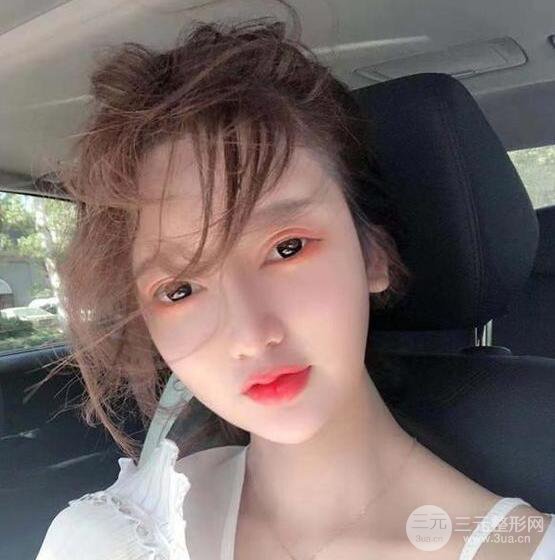 只是做了隆鼻整形改變居然辣么大，快來(lái)看看我的隆鼻整形恢復(fù)日記叭